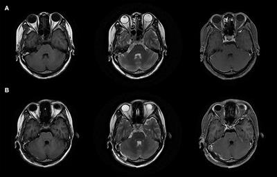 Trigeminal neuralgia caused by cavernoma: A case report with literature review